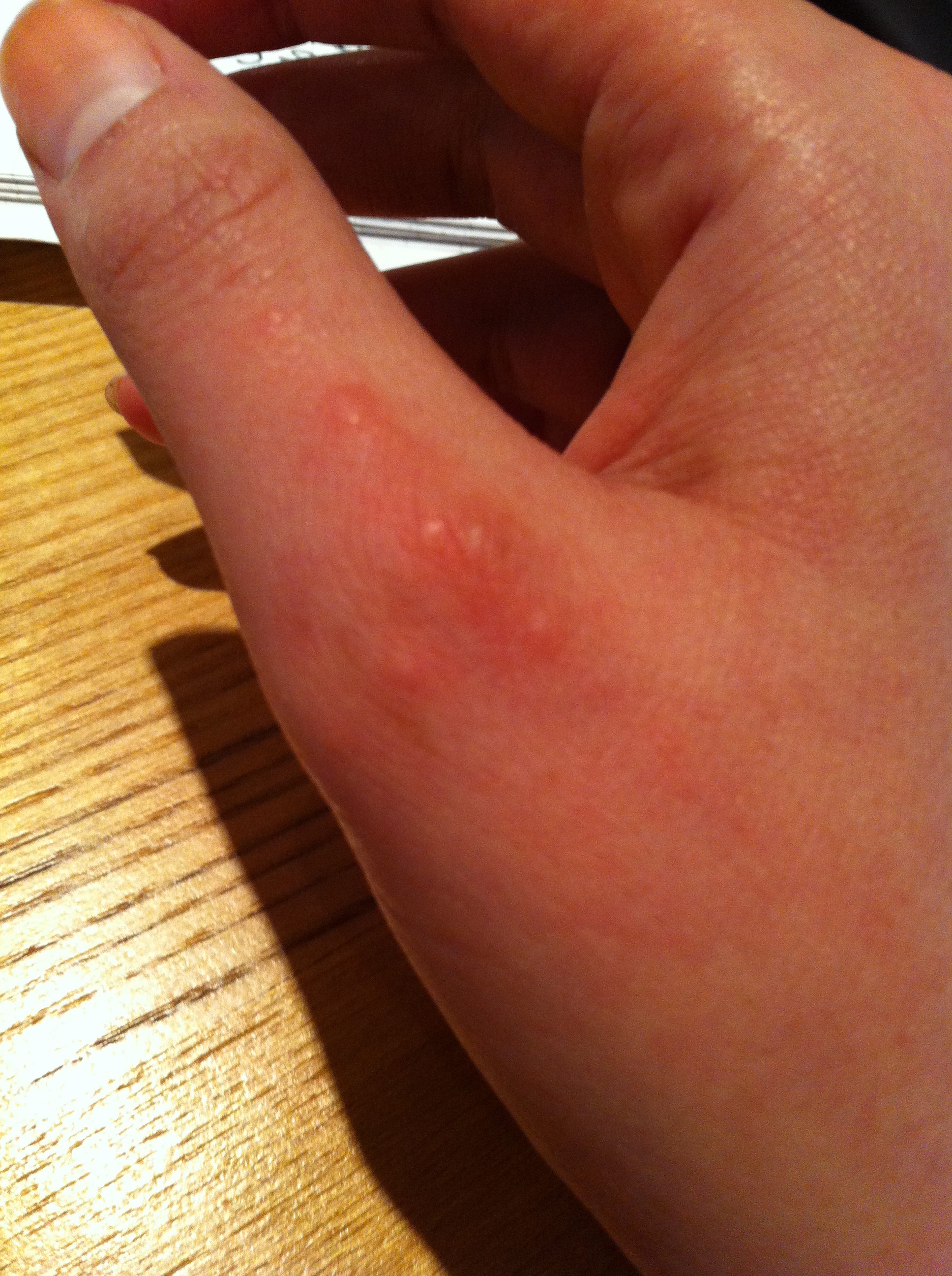 clear blisters on hands - Dermatology - MedHelp