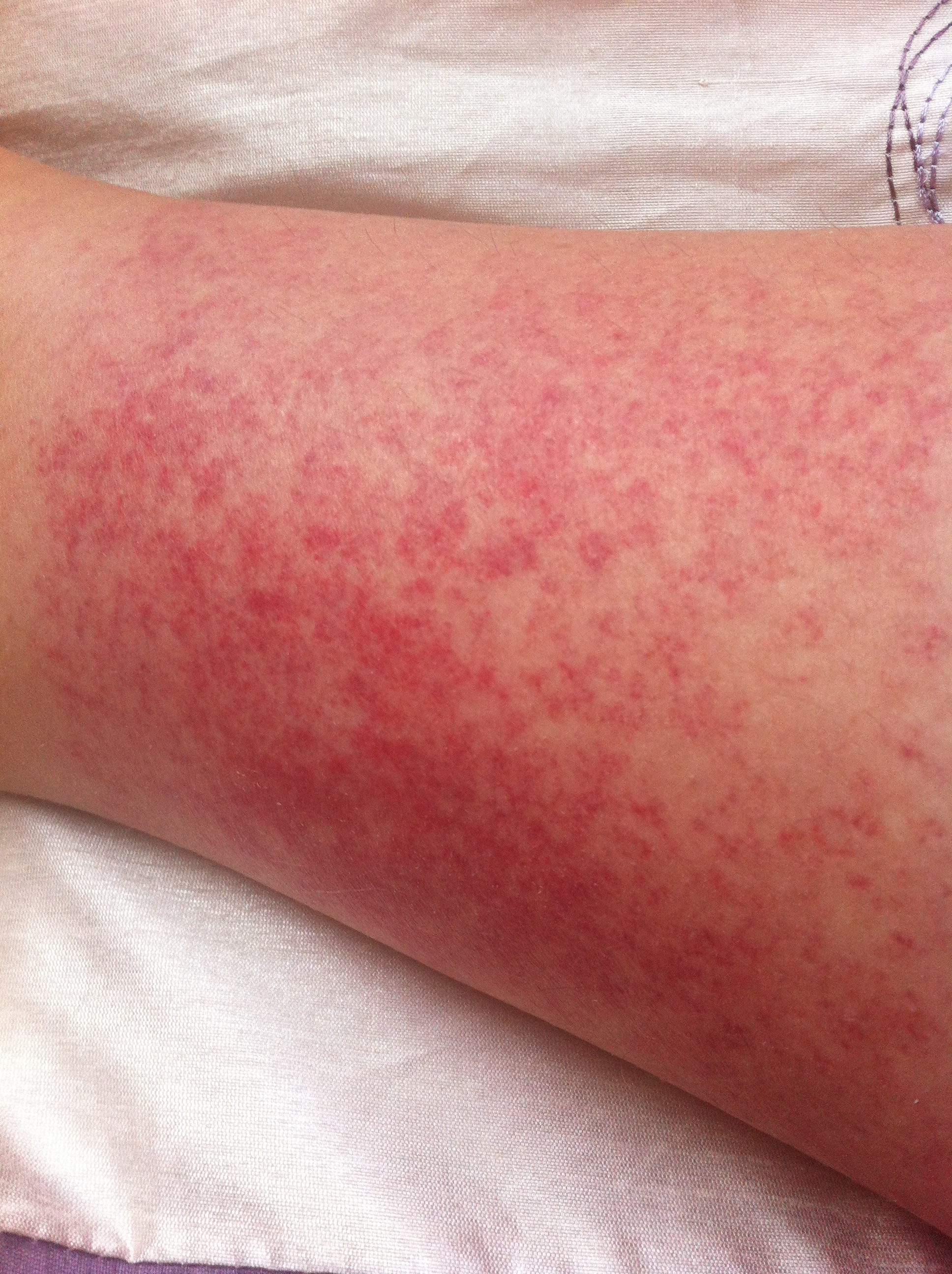 Unexplained Rash On Legs 37